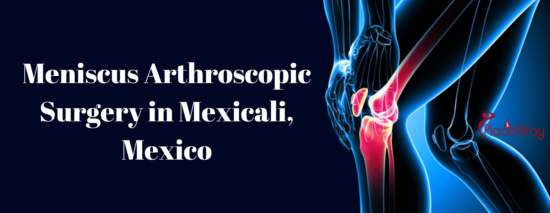 Popular Package for Meniscus Arthroscopic Surgery in Mexicali, Mexico